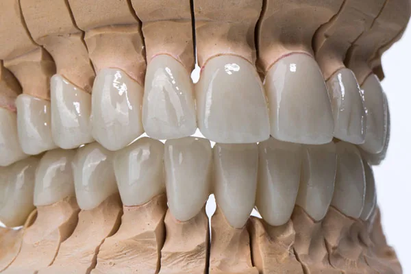 Dental zircon ceramic crowns on model / two jaw