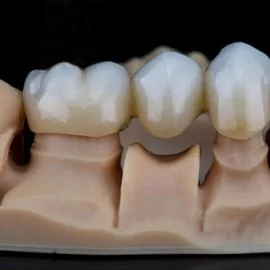 zirconium dental crowns on a model made on a 3D printer, shot on black glass with reflection