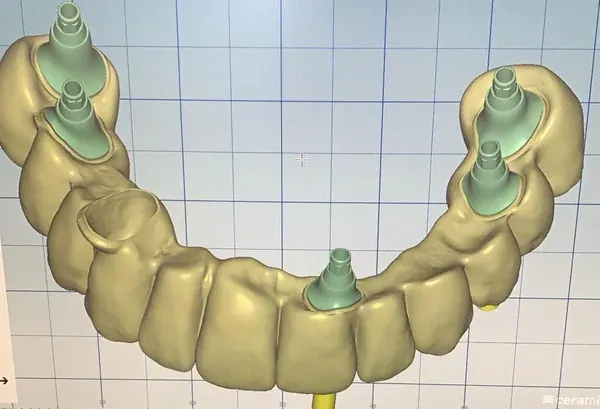 Top Zirkon – Cad cam