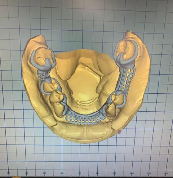 Top Zirkon – Cad cam 3