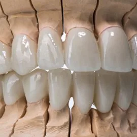 Dental zircon ceramic crowns on model / two jaw